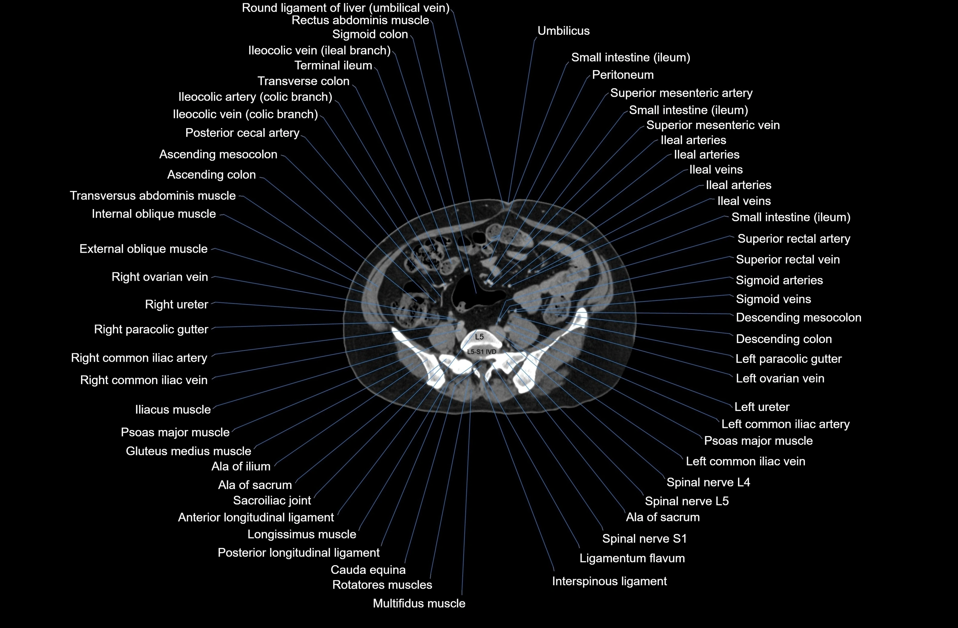 CT Abdomen axial cross sectional anatomy labelled radiology image-00062.webp